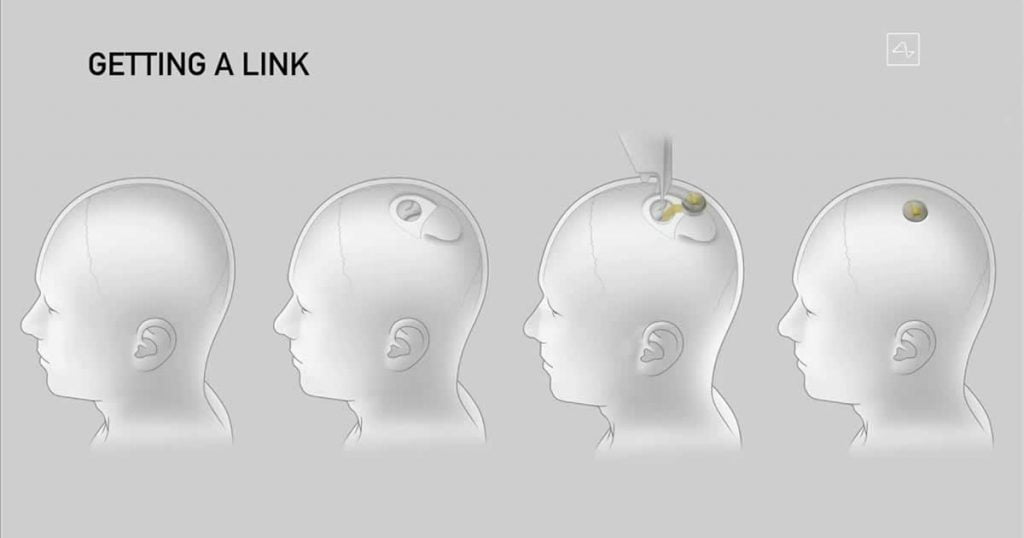 prototype of Neuralink brain implant