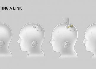 Neuralink Receives FDA Approval to Begin Human Trials for Brain Implant prototype of Neuralink brain implant