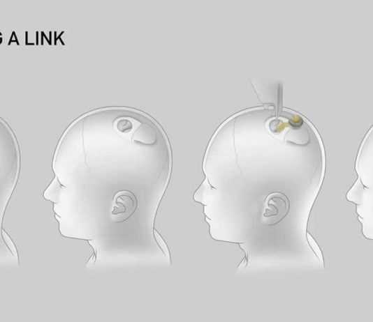 prototype of Neuralink brain implant