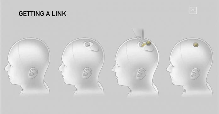 Neuralink Receives FDA Approval to Begin Human Trials for Brain Implant